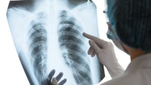 Casos de tuberculosis en México: ¿Cuáles Hjo los Síntomas?