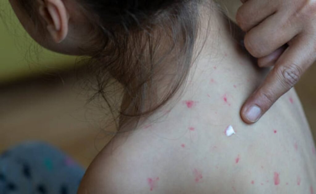 Sarampión en México se dispara en 2026, los casos aumentan 137% y superan cifras de 2025